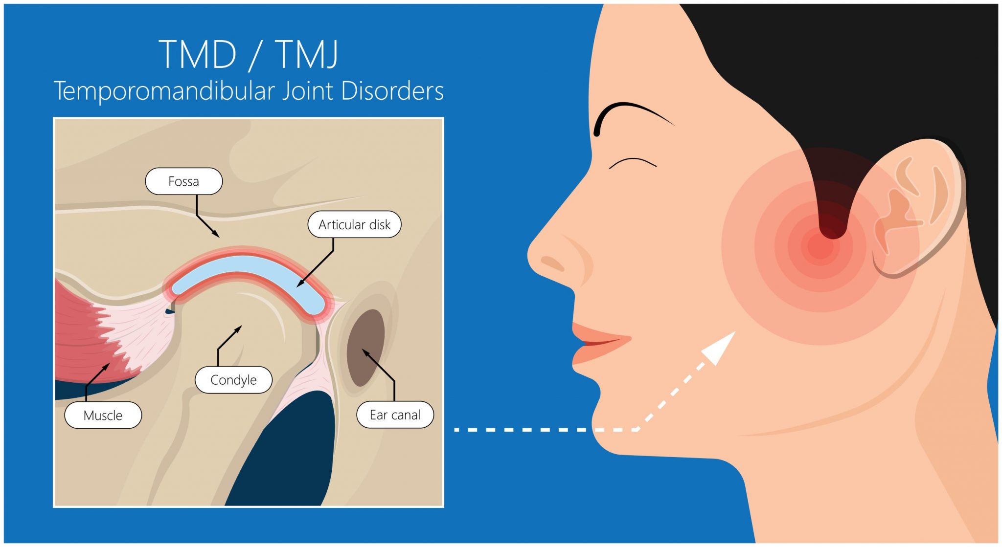 Tmj Line TMJ Treatment Houston | TMJ Disorders Houston TX | TMJ Specialist in ...