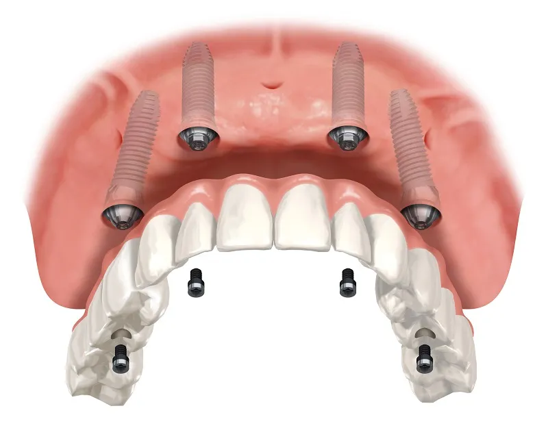 An illustration of a All-on-4 implant system