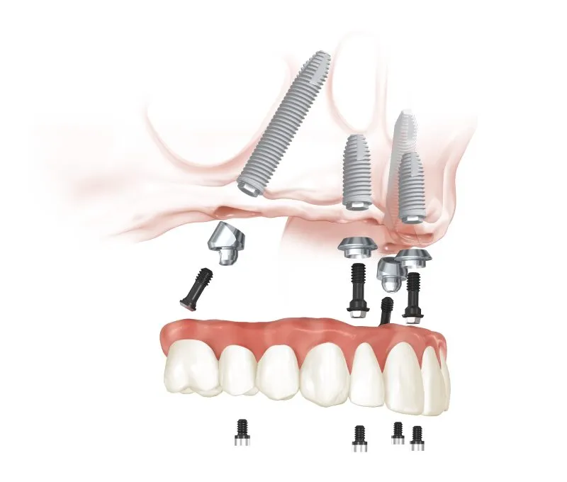 An image of a dental implant procedure, specifically an All-on-4 implant system