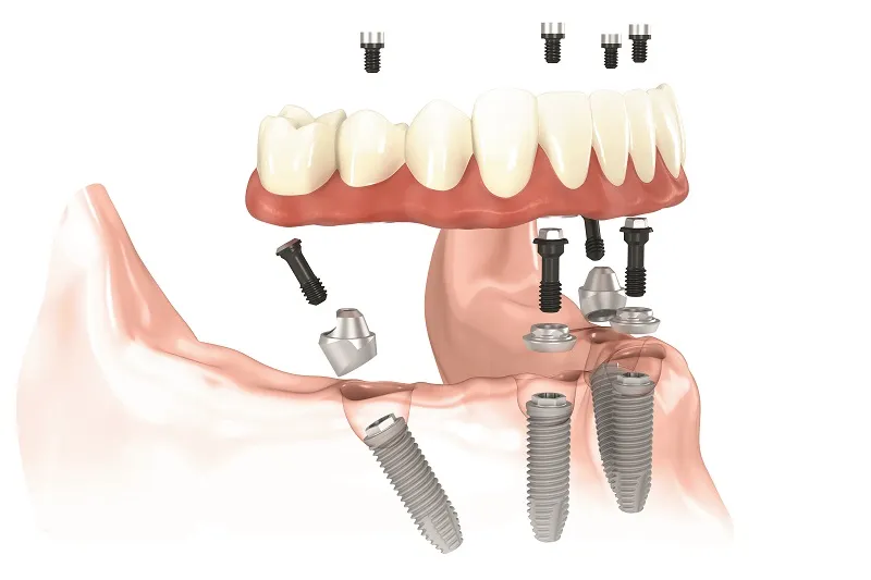 All-on-4® Treatment Concept illustration