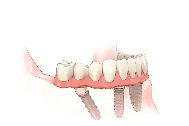 All-on-4® Treatment Concept illustration