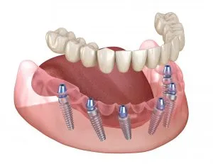 full mouth implants houston tx